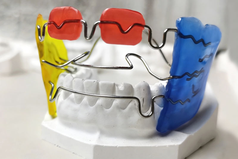 Don't Miss the "Golden Period" for Correcting Your Child's Facial Profile: Understanding the Frankel-3 Appliance Don't Miss the "Golden Period" for Correcting Your Child's Facial Profile: Understanding the Frankel-3 Appliance