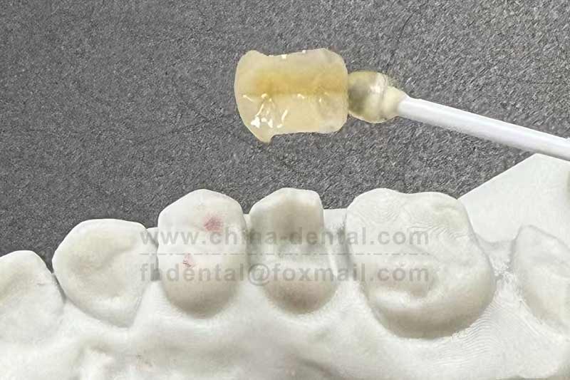 Porcelain Inlay: Minimally Invasive Restoration for Long-Term Protection of Natural Teeth Porcelain Inlay: Minimally Invasive Restoration for Long-Term Protection of Natural Teeth