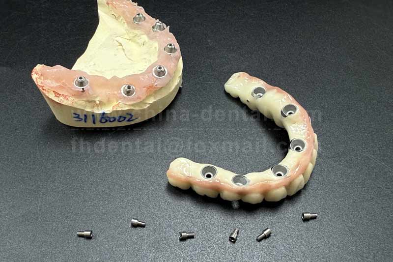 No Need to Fear Multiple Missing Teeth – Implant-Supported Bridges Make Restoration Easier