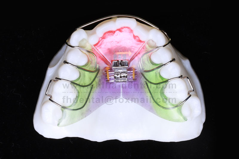 Removable Three-Dimensional Expander: An Ideal Assistant for Correcting Crossbite in Mixed Dentition