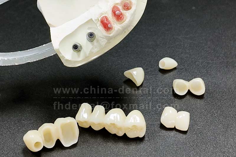 Say Goodbye to Dental Troubles: All-Ceramic Crowns Create a Perfect Smile for You