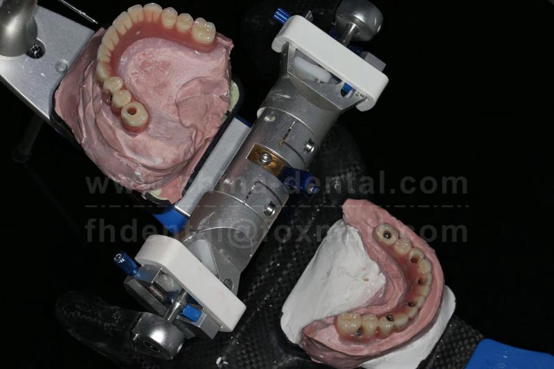 Unstable removable dentures? Dreading bone grafting? All-On-X Implants Bring a Brand-New Restoration 