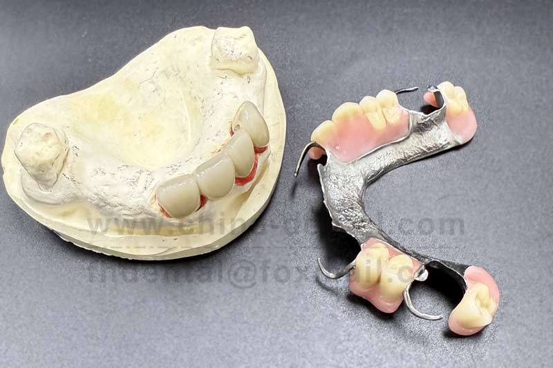 Cast Partial: A Stable Foundation for Complex Oral Conditions