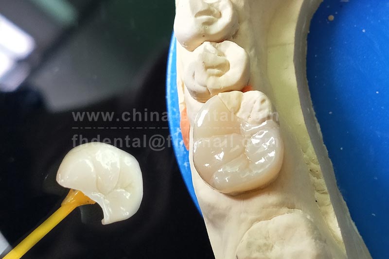 No Matter How Well You Fill a Cavity, an Inlay Fits Better