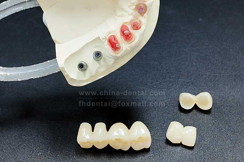 All-ceramic crowns – a long-lasting, durable restoration option for your teeth