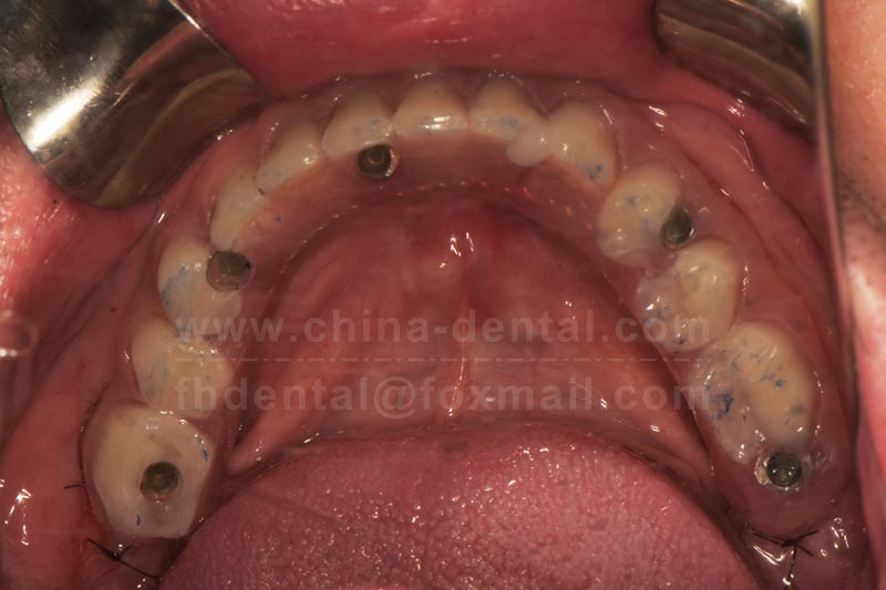 Say goodbye to large incisions and easily choose ＂All-on-X＂ implant treatment.