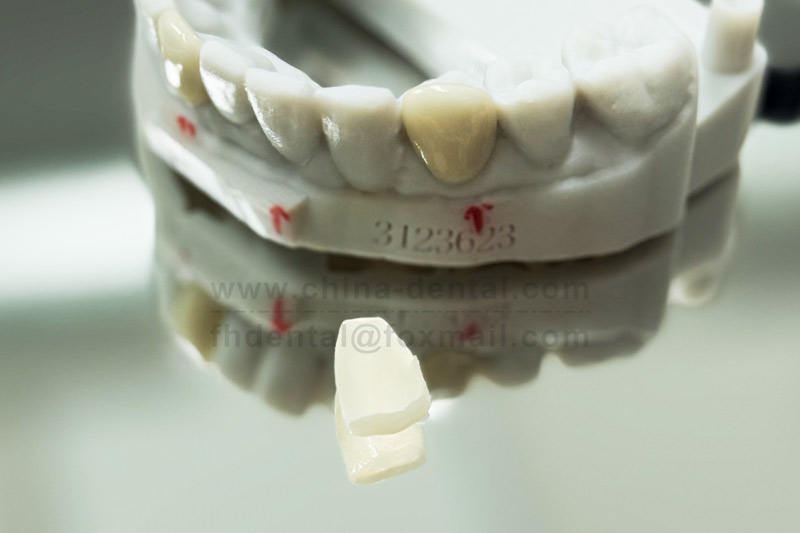 Porcelain veneers look like natural teeth and feel unnoticeable when worn