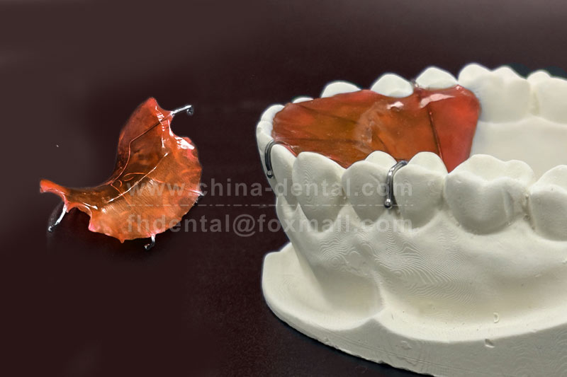 Removable Maxillary Guide Plate – A Flexible and Convenient Solution for Deep Overbite Correction