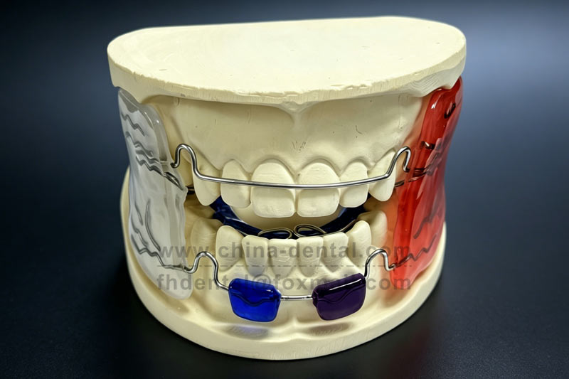 Overjet and Mandibular Retrusion in Children? Try the Frankel 2 Appliance