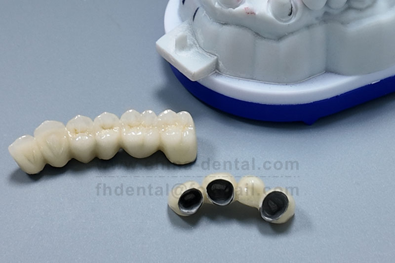 Don't Let Your Guard Down After Root Canal Treatment – A Porcelain-Fused-to-Metal Crown Armors the 