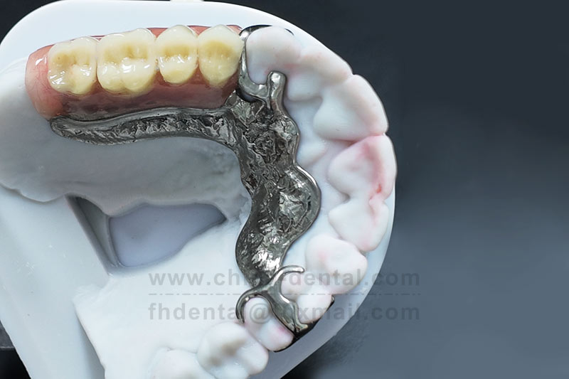 Say Goodbye to Embarrassing Looseness – Removable Partial Dentures Are Sturdy, Durable, and Worry-Free