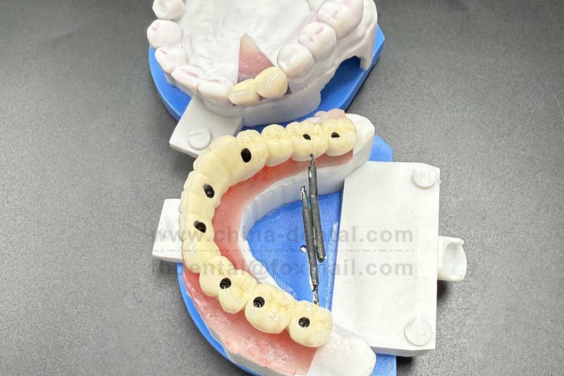 Don’t replace multiple missing teeth one by one — implant-supported bridges save you from extra surgeries and expenses. Don’t replace multiple missing teeth one by one — implant-supported bridges save you from extra surgeries and expenses.