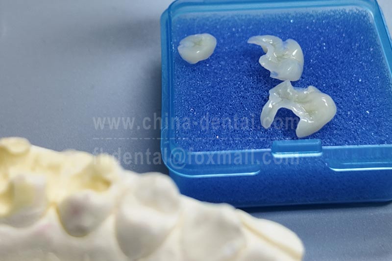 Recurrent fillings keep falling out? Try ceramic inlays