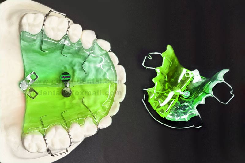 Fan-shaped Expander – An orthodontic choice that doesn't cause suffering for children