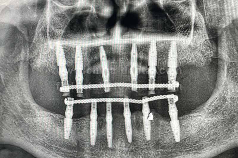 Don’t put up with total tooth loss any longer – All-on-X implants give you a new, non-wobbly set of teeth