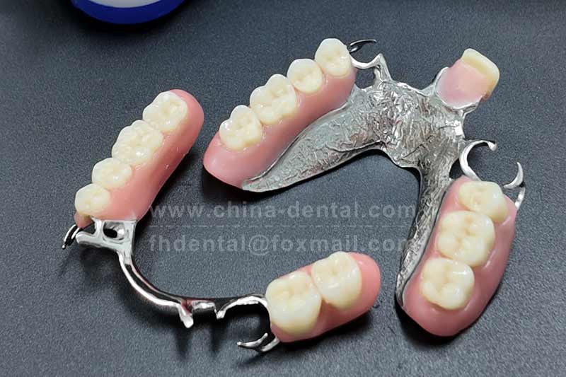 Poor Ridge Conditions Are No Longer a Concern – Metal Framework Dentures Use Rigid Strength to Deli