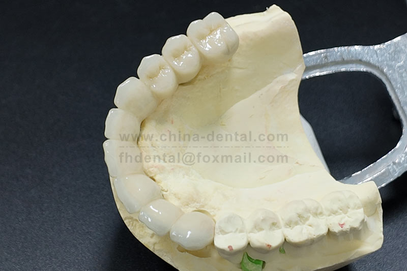 Don’t tough it out with a chipped or missing tooth – all-ceramic crowns let you smile with confid