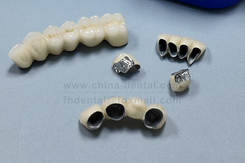 PFM Crowns – A Practical Choice Balancing Strength and Aesthetics