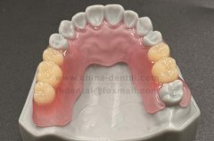 Flexible Partial: A Natural Choice for Temporary Restoration and Transitional Phases