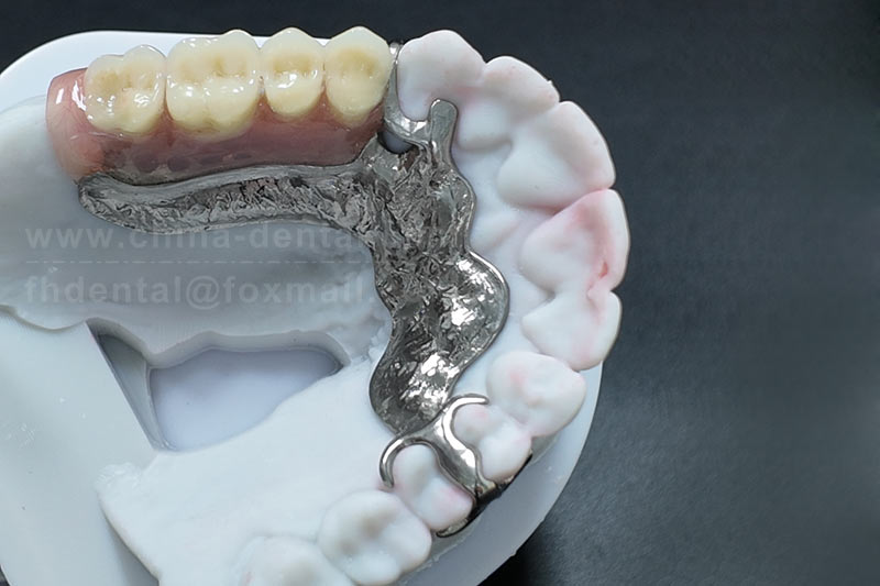 Say Goodbye to Sore Gums from Ill-Fitting Dentures – Steel Framework Dentures Let Seniors Eat More Comfortably Say Goodbye to Sore Gums from Ill-Fitting Dentures – Steel Framework Dentures Let Seniors Eat More Comfortably
