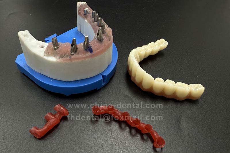 Don’t fear multiple missing teeth – implant-supported bridges give you a firm, functional smile