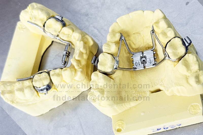 Hyrax Rapid Expander – resolving dental crowding from the skeletal root cause.