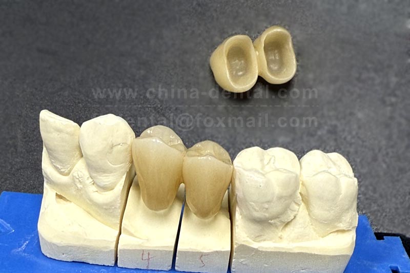 Give your fragile teeth a ＂safety helmet＂—all-ceramic crowns let you chew with confidence.