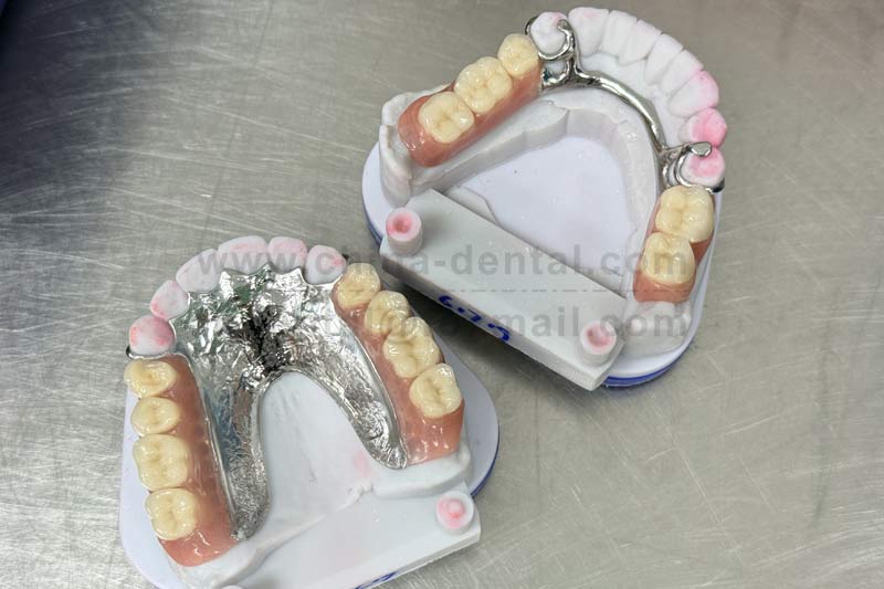 Missing multiple teeth scattered around? Removable partial dentures help you regain chewing confidenc