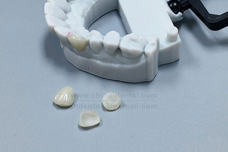 Minimal grinding, maximum transformation — porcelain veneers for a beautifully confident smile.