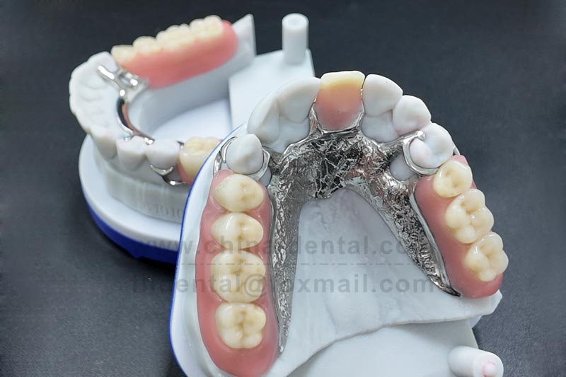 Metal Framework Partial Denture – A Stable Restoration Solution That Remains Reliable for Years