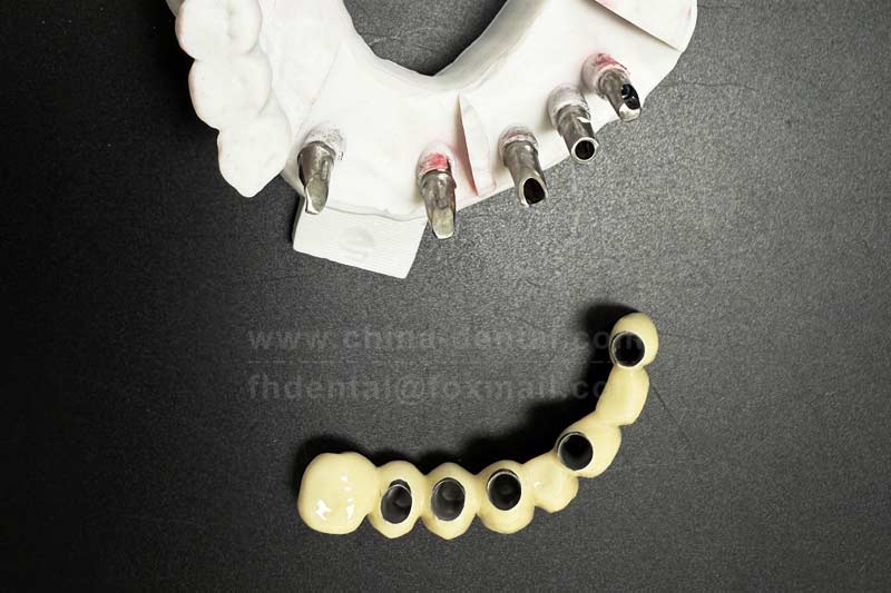 Multiple missing teeth do not have to be something you settle for—implant bridge crowns can help rebuild a complete dentition. Multiple missing teeth do not have to be something you settle for—implant bridge crowns can help rebuild a complete dentition.