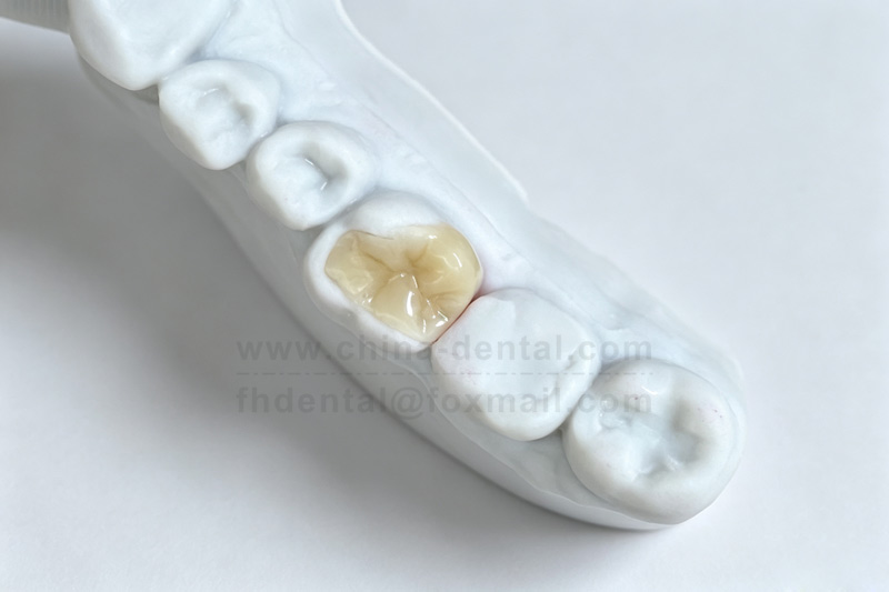 Say Goodbye to Repeated Fillings: Ceramic Inlays Make Restorations Last Longer