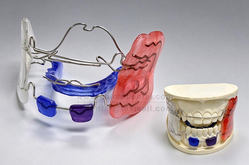 Frankel 2: Guiding Children to Improve “No Chin” and “Buck Teeth” During the Golden Growth Period Frankel 2: Guiding Children to Improve “No Chin” and “Buck Teeth” During the Golden Growth Period