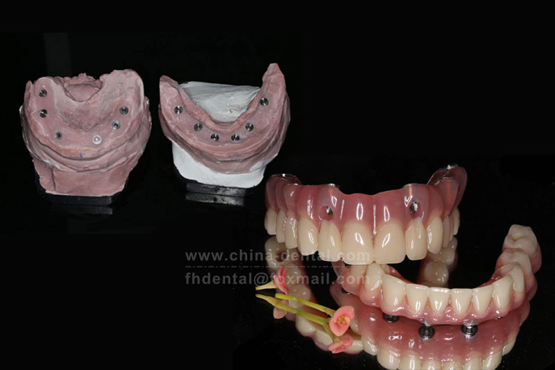 Say Goodbye to Full-Mouth Tooth Loss: ALL-ON-X Implants Help You Regain Fixed Teeth the Same Day