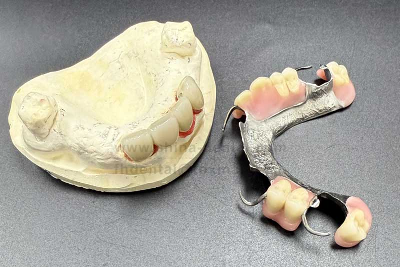 Multiple Missing Teeth in Scattered Positions: A Partial Denture Can Help You Regain Confidence in Chewing